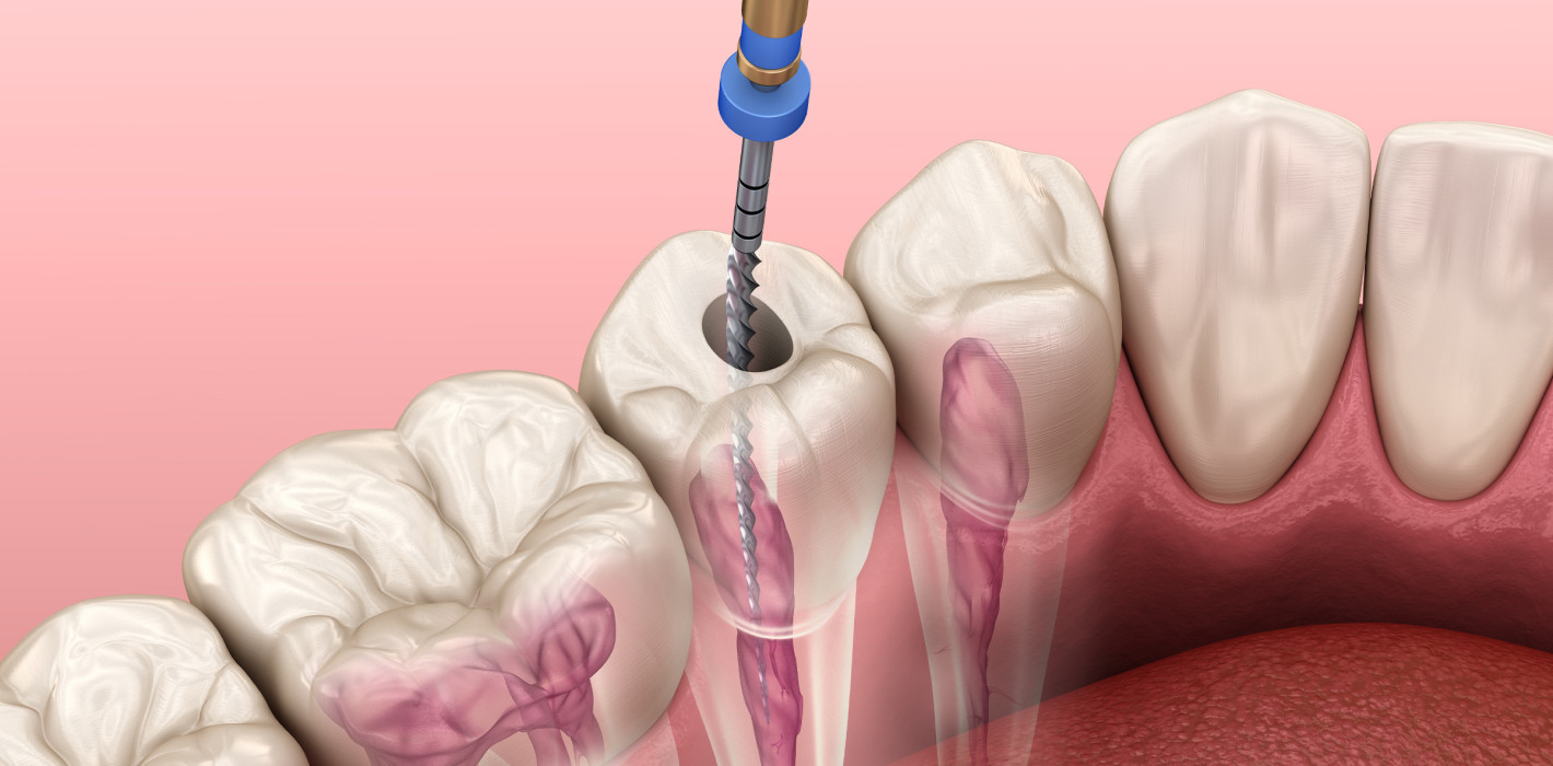 ROOT CANAL